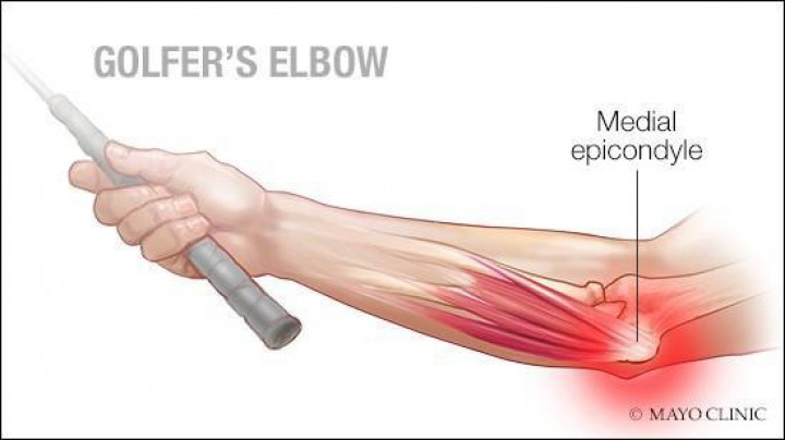 Hội chứng Golfer's Elbow: Những Điều Cần Biết